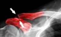 Bone regeneration with magnetic nanoparticles