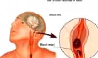 Brain nerve circuit changes lead to ma chi pain