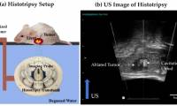 Breakthrough: An ultrasound technique helps destroy liver cancer tumors without surgery
