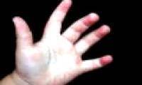 Causes and ways of coping when children sweat a lot of hands and feet