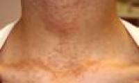 Cautious skin diseases caused by rain and wading flooded water