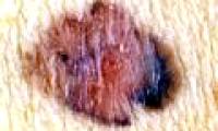Cloning immune cells to treat cancer