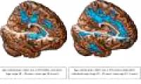 Cocaine wreaks havoc on the brain
