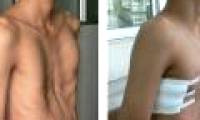 Congenital chest concave and health consequences