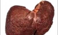 Correctly identify signs of liver cancer