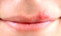 Cure cold sores in the lips