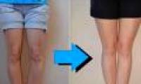 Curved legs turn into straight legs: It turns out people have suffered this much