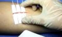Dermaclip - Wound patch for people who are afraid of pain