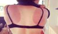 Dermatologists recommend the 3 fastest ways to remove sunburns