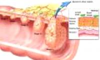 Detecting a mutant gene can prevent cancer from spreading