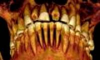 Detecting mummies dying from tooth decay
