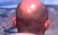 Detection of male pattern baldness