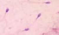 Detection of sperm structure may contribute to infertility