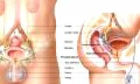 Determination of prostate cancer by urine test