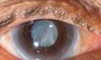 Develop drugs to help dissolve cataract