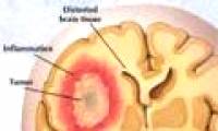 Develop new technology for early detection of brain tumors