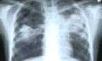 Diabetes and the risk of increased pulmonary tuberculosis