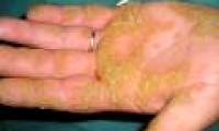 Discovered genes that cause skin spots