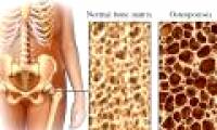 Discovered many new genes related to osteoporosis