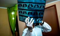 Discovering a gene that doubles the risk of lung failure and death from Covid-19
