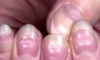 Disease signs appear on nails