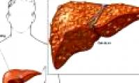 Early signs of cirrhosis