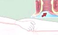 Early signs warn you about anal cancer