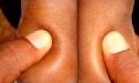 Edema - a sign of many dangerous diseases