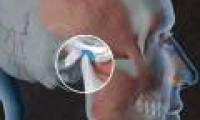 Expression and treatment of temporomandibular dysfunction