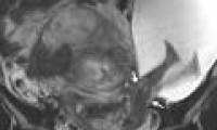 Extremely rare images of babies with legs growing outside the uterus
