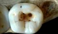 Find out how to cure the teeth of the ancient people