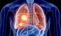 Find out the reason why more and more young people get cancer