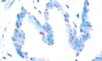 Find the clues that cause cancer resistance
