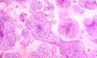 Finding 110 new genes causes breast cancer