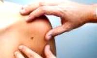First blood test to detect melanoma early
