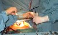 First implantation of heart and bone marrow transplantation