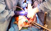 First successful pig kidney transplant for brain dead people