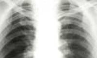 Further detection of new EMC virus causes pneumonia