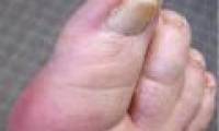 Gout or arthritis?
