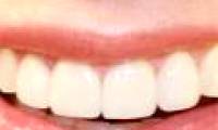 Guess the personality and guess the disease through teeth