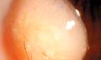 Hair growth in eyeballs