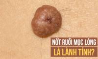 Hair growth on moles does not cause cancer and can be removed: Is that true?