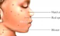 Hand and foot and mouth disease increased in Hanoi