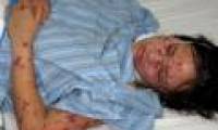 Hanoi recorded the first case of dangerous meningococcal encephalitis