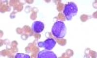 Hope for leukemia patients
