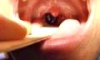Horror story is true: what will happen if the parasite leeches in the throat?