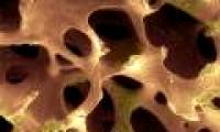How to detect osteoporosis at the earliest stage