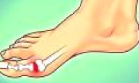 How to limit the terrible pain caused by gout