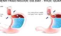How to prevent stomach acid reflux