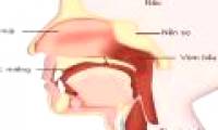 How to recognize early types of head and neck cancer